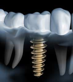 Implantate